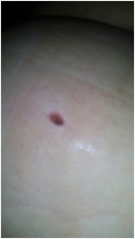 Лікар зробив укол від алергії: під Херсоном мати двох дітей гниє заживо (оновлено)